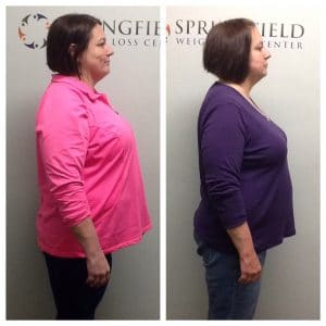 Springfield IL Weight Loss Before and After Springfield Weight Loss Center