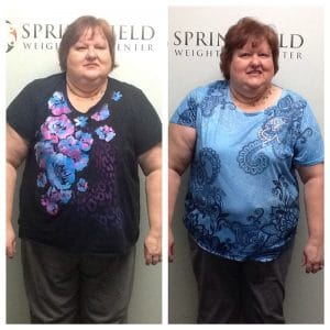 Springfield IL Weight Loss Before and After Springfield Weight Loss Center