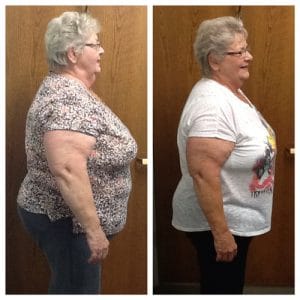 Springfield IL Weight Loss Before and After Springfield Weight Loss Center