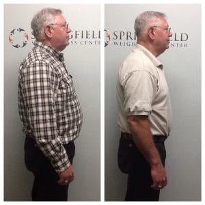 Springfield IL Weight Loss Before and After Springfield Weight Loss Center