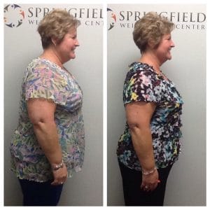 Springfield IL Weight Loss Before and After Springfield Weight Loss Center