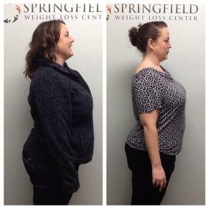 Springfield IL Weight Loss Before and After Springfield Weight Loss Center