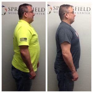 Springfield IL Weight Loss Before and After Springfield Weight Loss Center