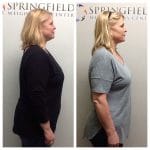 Springfield IL Weight Loss Before and After Springfield Weight Loss Center