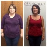 Springfield IL Weight Loss Before and After Springfield Weight Loss Center