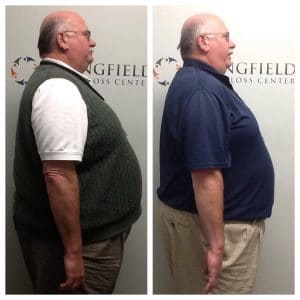 Springfield IL Weight Loss Before and After Springfield Weight Loss Center