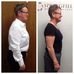 Springfield IL Weight Loss Before and After Springfield Weight Loss Center