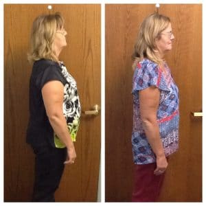 Springfield IL Weight Loss Before and After Springfield Weight Loss Center