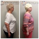 Springfield IL Weight Loss Before and After Springfield Weight Loss Center