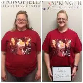 Springfield IL Weight Loss Before and After Springfield Weight Loss Center