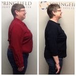 Springfield IL Weight Loss Before and After Springfield Weight Loss Center