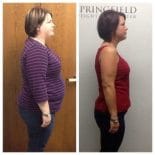 Springfield IL Weight Loss Before and After Springfield Weight Loss Center