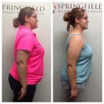 Springfield IL Weight Loss Before and After Springfield Weight Loss Center