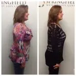 Springfield IL Weight Loss Before and After Springfield Weight Loss Center