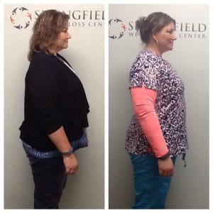 Springfield IL Weight Loss Before and After Springfield Weight Loss Center