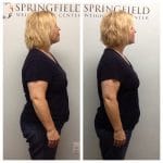 Springfield IL Weight Loss Before and After Springfield Weight Loss Center