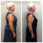 Springfield IL Weight Loss Before and After Springfield Weight Loss Center