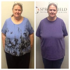 Springfield IL Weight Loss Before and After Springfield Weight Loss Center