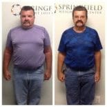 Springfield IL Weight Loss Before and After Springfield Weight Loss Center