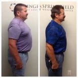 Springfield IL Weight Loss Before and After Springfield Weight Loss Center