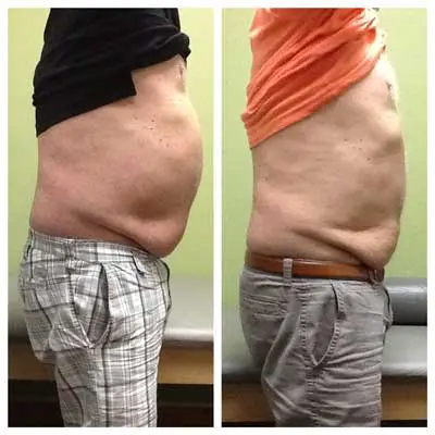 Before-and-After-Weight-Loss Weight Loss Before and After
