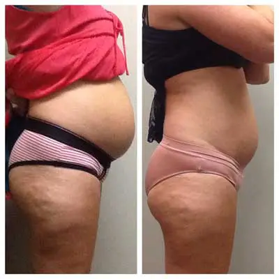 Weight-Loss-Before-and-After Weight Loss Before and After